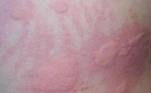哈尔滨肤康皮肤病医院不同类型荨麻疹怎么确诊？